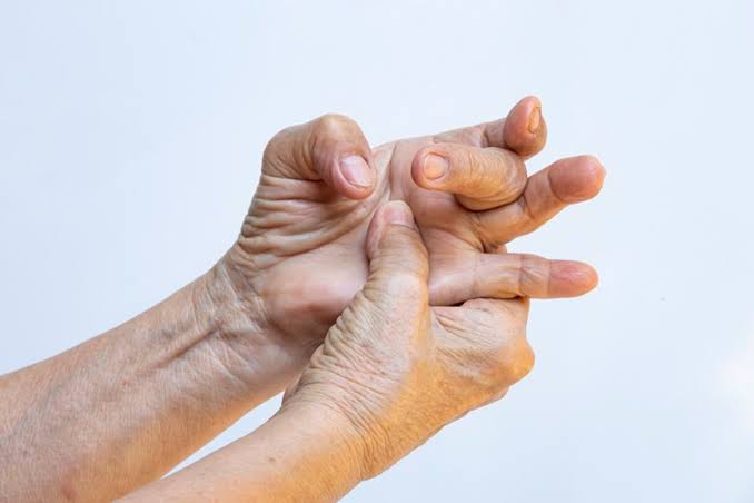 Ecografía dinámica del tendón flexor en dedo en resorte: engrosamiento de la polea A1