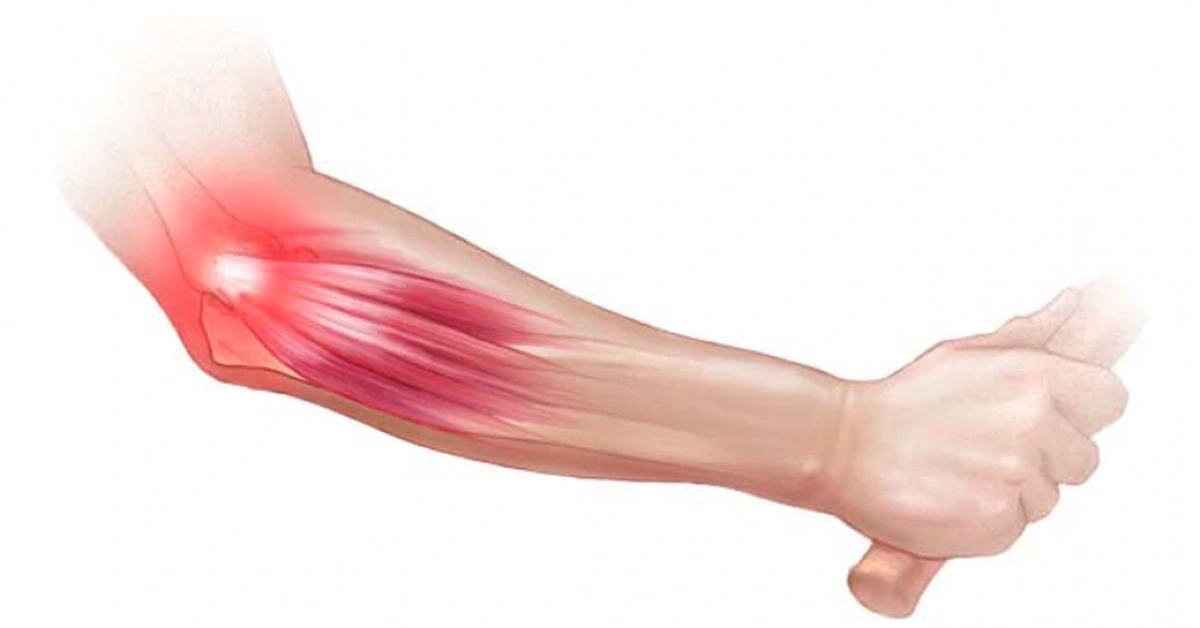 Localización del dolor en epicondilitis o codo de tenista: cara lateral del codo