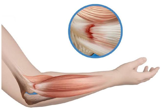 Imagen ecográfica de tendinopatía epicondílea: engrosamiento y alteración fibrilar del tendón extensor