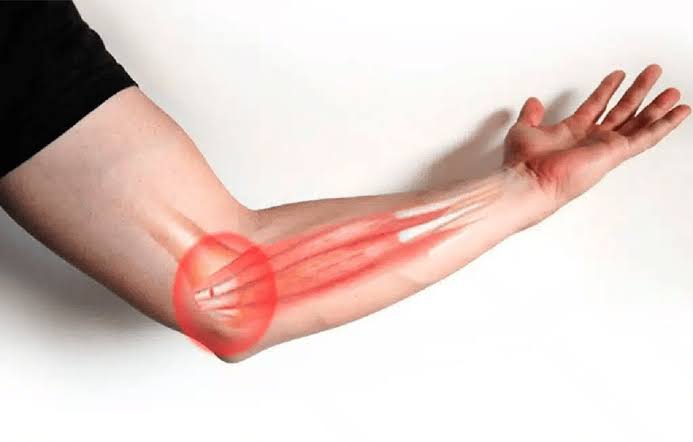 Localización del dolor en epitrocleitis: cara interna del codo y origen de los flexores