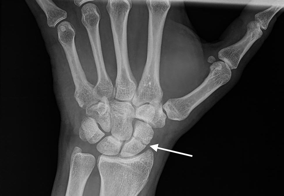 Imagen radiográfica y ecográfica de fractura de escafoides en muñeca