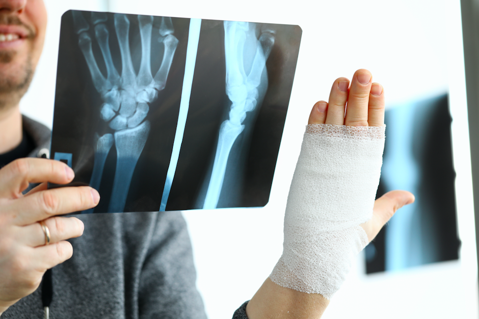 Anatomía del radio distal y tipos de fractura de muñeca