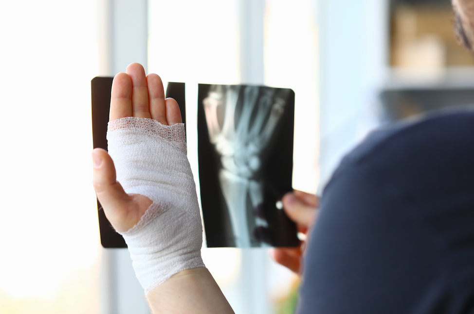 Radiografía de fractura de radio distal desplazada con angulación dorsal