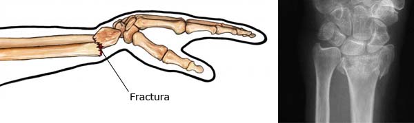 Rehabilitación de muñeca tras fractura de radio distal: ejercicios de movilidad y recuperación funcional